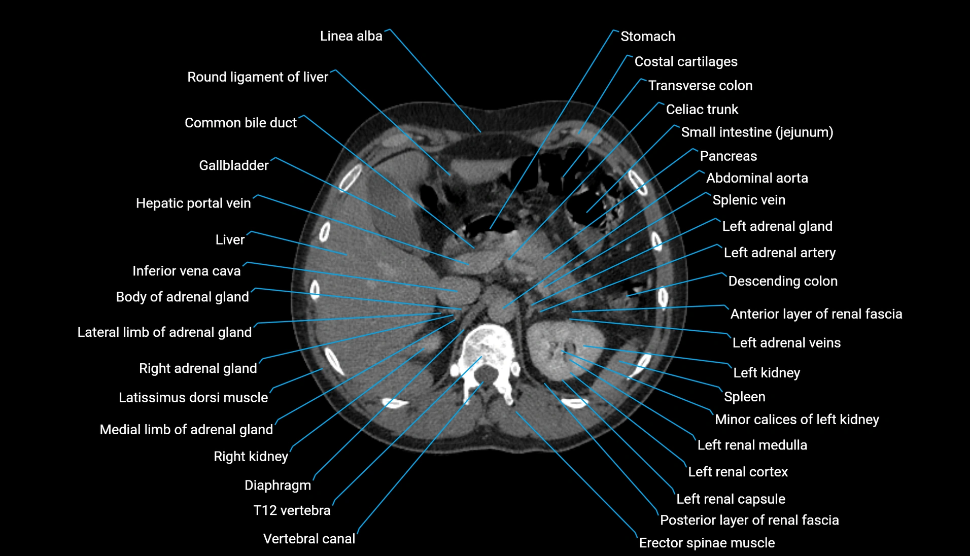 CT urogram axial cross sectional anatomy  labelled radiology image-00078.webp